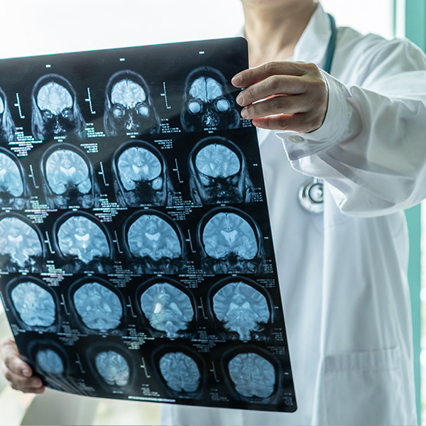 This image shows a medical professional, likely a radiologist or neurologist, holding up an X-ray with a detailed view of the brain.