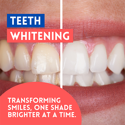 The image is a side-by-side comparison of a person's teeth before and after a dental whitening treatment. The left side shows yellowed teeth, while the right side displays bright white teeth, indicating the transformation achieved through the service advertised in the image.